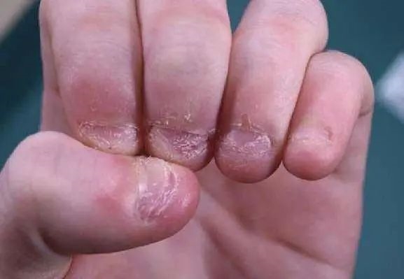甲亢遇到异食癖：法国男子一顿吃15人份 急了还吃石头木塞
